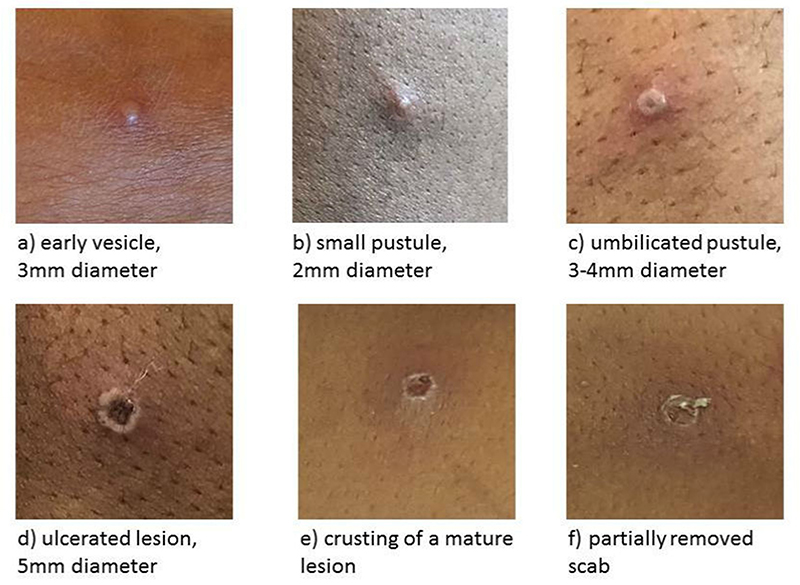 Stages of Monkey Pox - UK HSA