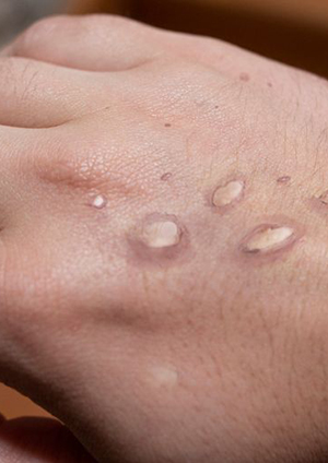 Monkey Pox Hand Lesions