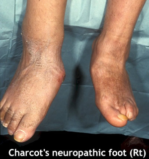 Charcot's ankle