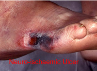 Photo of neuroischaemic foot ulcer