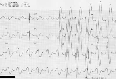 Hyperkalaemic ECG