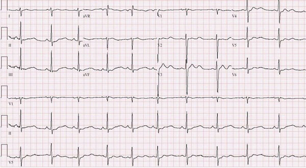 Hypokalaemia