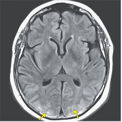 FLAIR Occipital Oedema