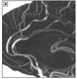 CTA in RCVS