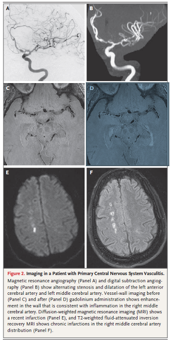 Imaging in PACNS