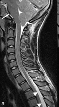 MRI Findings in Post LP Headache