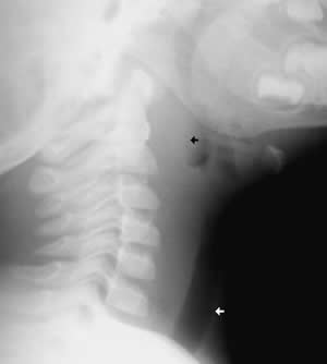 retro-pharyngeal abscess1