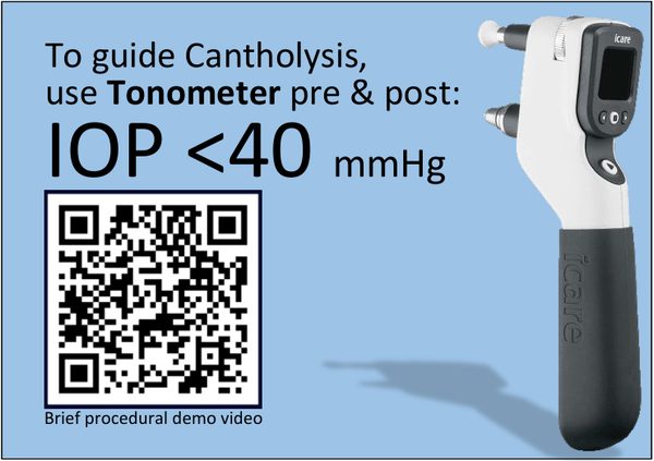 To guide cantholysis, use tonometer pre and post: IOP less than 40 mmHg. QR code to brief procedural demo video