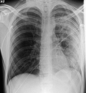 CXR post intercostal drain - thank you BMJ for educational image