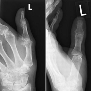 OA thumb X-ray