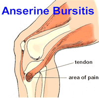 Anserine bursitis diagram