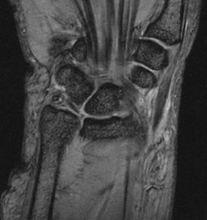 T2-weighted MRI image sequence showed abnormal segmental tendinous thickening involving the first dorsal extensor component of the wrist just proximal the radial styloid process, with a mild amount of fluid within the tendon sheath.
