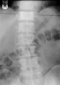 Sclerotic prostatic Secondary in Body of T12