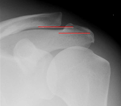 ACJoint measurement on X-ray