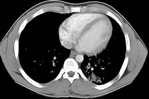 Alveolar-type attenuations throughout, focused in the left lower lobe