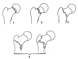 evans hip fracture classification