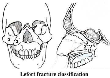 le Fort diagram1