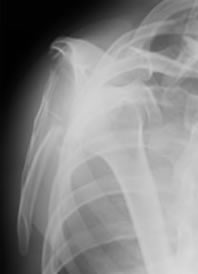Fracurted Scapula Lateral X-ray