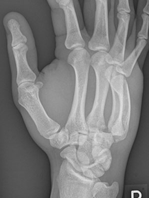 Dislocated CMC Joint