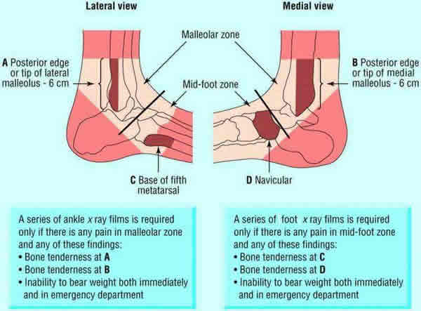 Ottawa Ankle Rules