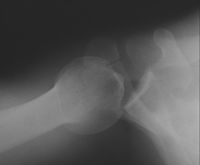 Axillary View X-ray showing posteror subluxation