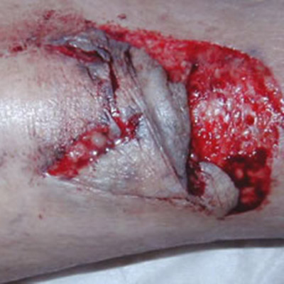 Pre-tibial wound