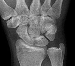 Scaphoid fracture