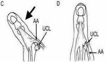 Stenner lesion