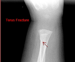 Torus fracture