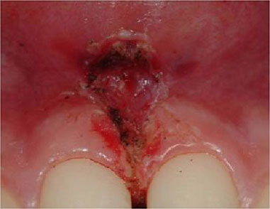 Upper lip frenulum laceration