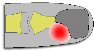 Location of paronychia pus