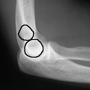 Elbow lateral figure of 8