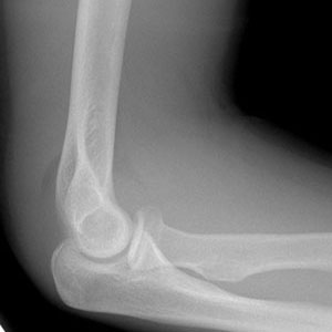 x-ray elbow lateral