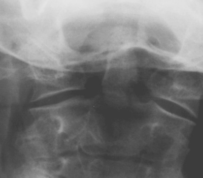 mechanism of injury in odontoid fracture