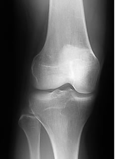x-ray knee AP