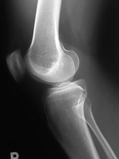 x-ray knee Lateral